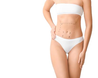 Tummy Tuck