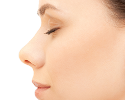 Secondary (Revision) Rhinoplasty