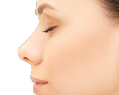 Rhinoplasty