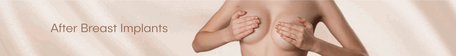 After Breast Implants